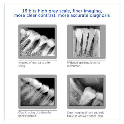 Sensores digitales de rayos X dentales para implantes dentales y tratamiento endodóntico